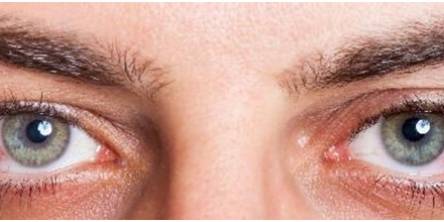 Dry Eyes